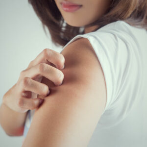 3 handy tips for managing eczema