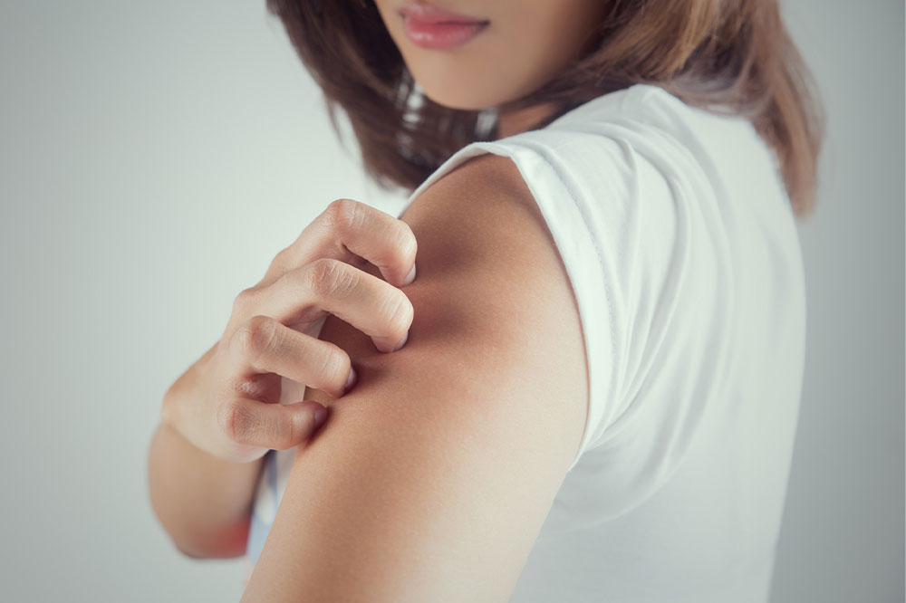 3 handy tips for managing eczema