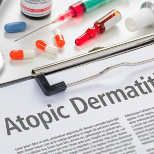 4 effective ways to manage atopic dermatitis