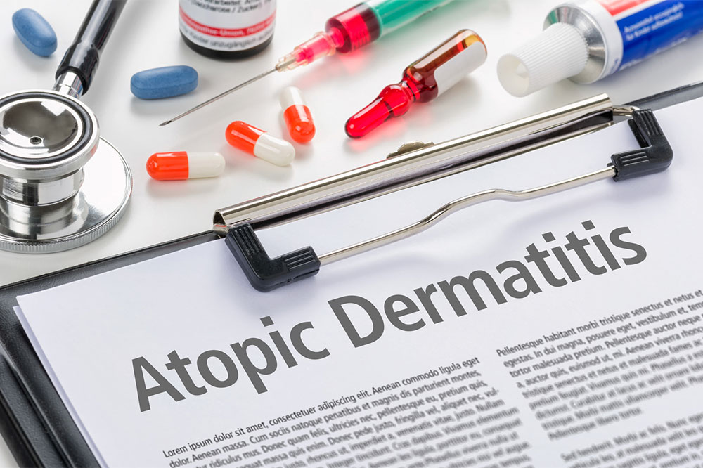4 effective ways to manage atopic dermatitis